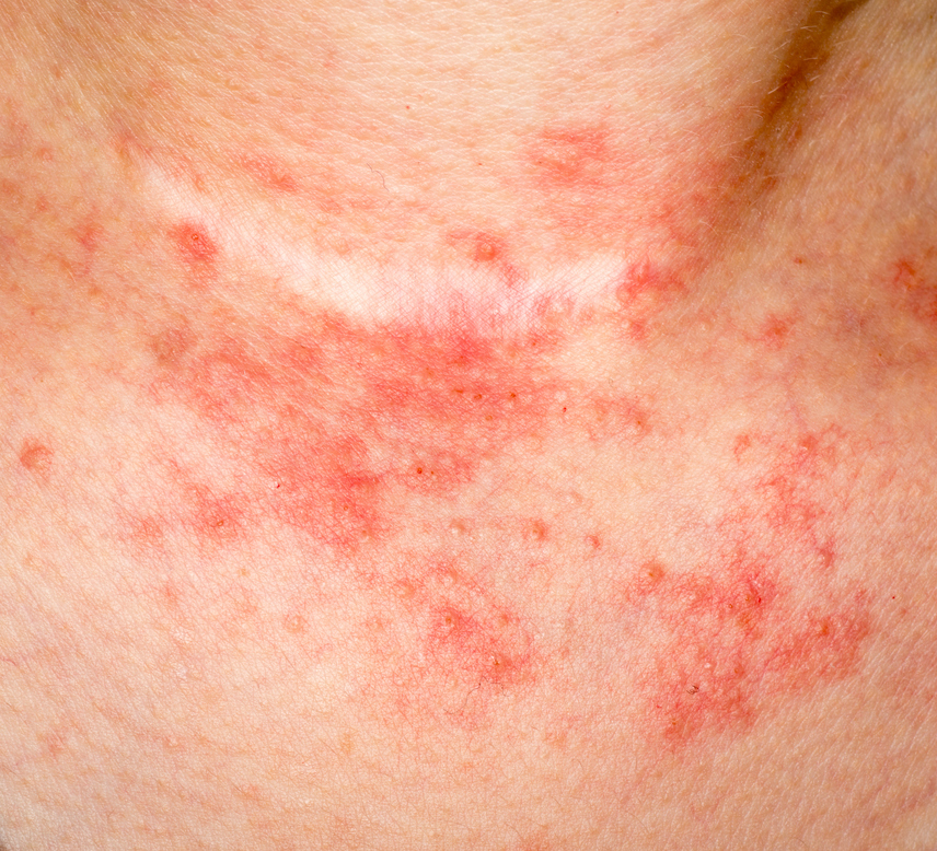 bőrallergia