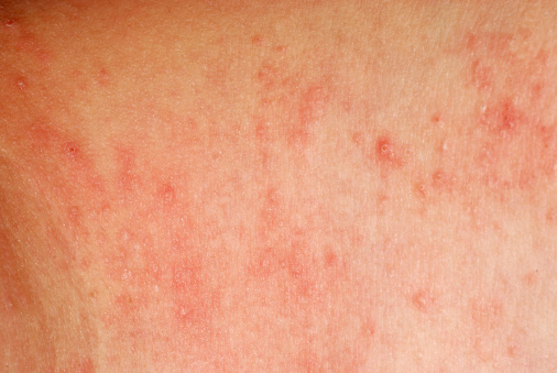 Bőrbetegség