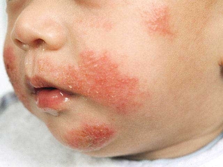 Csecsemő bőrbetegség