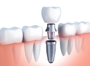 Fog implantátum